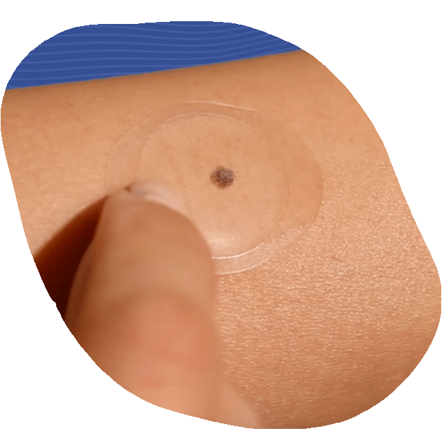DermTech_Sticker_On_Skin_2