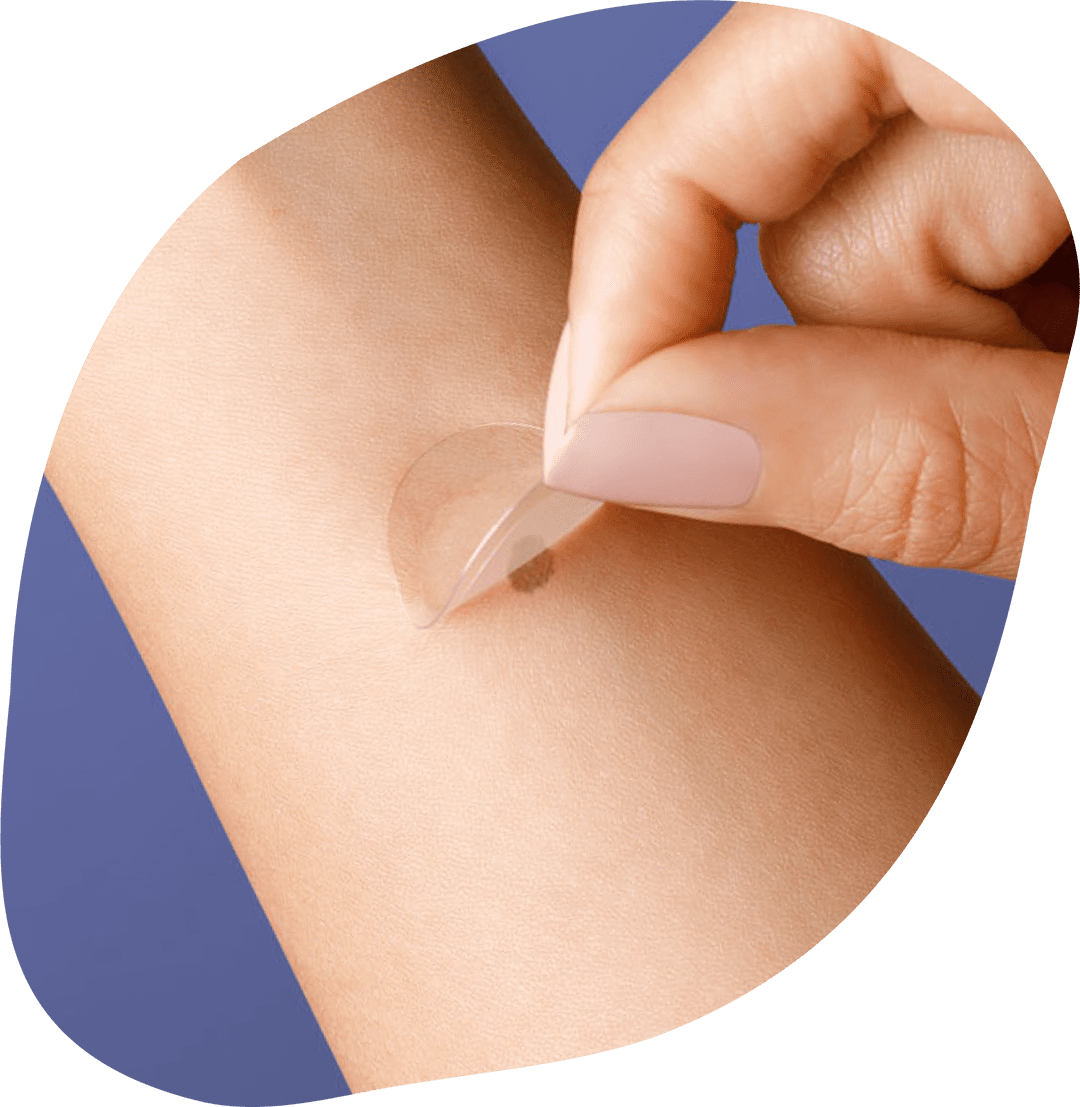 The DermTech Melanoma Test (PLA)