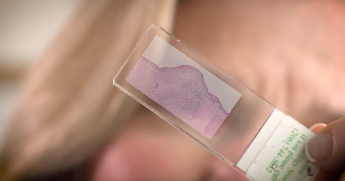 Skin Cancer Biopsy Can You Trust the Results? DermTech