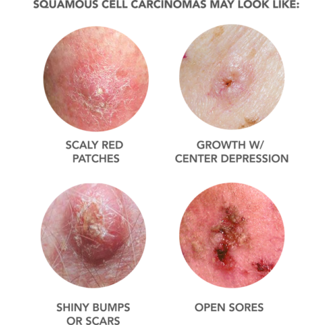 squamous carcinoma dermtech carcinome